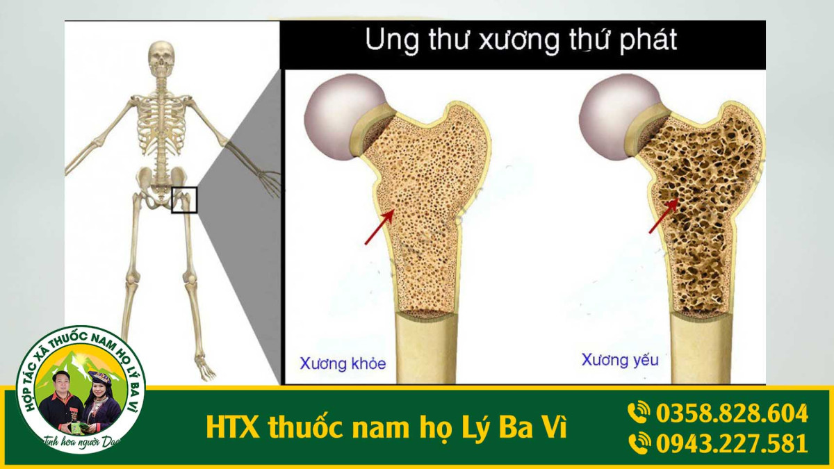 xương khớp