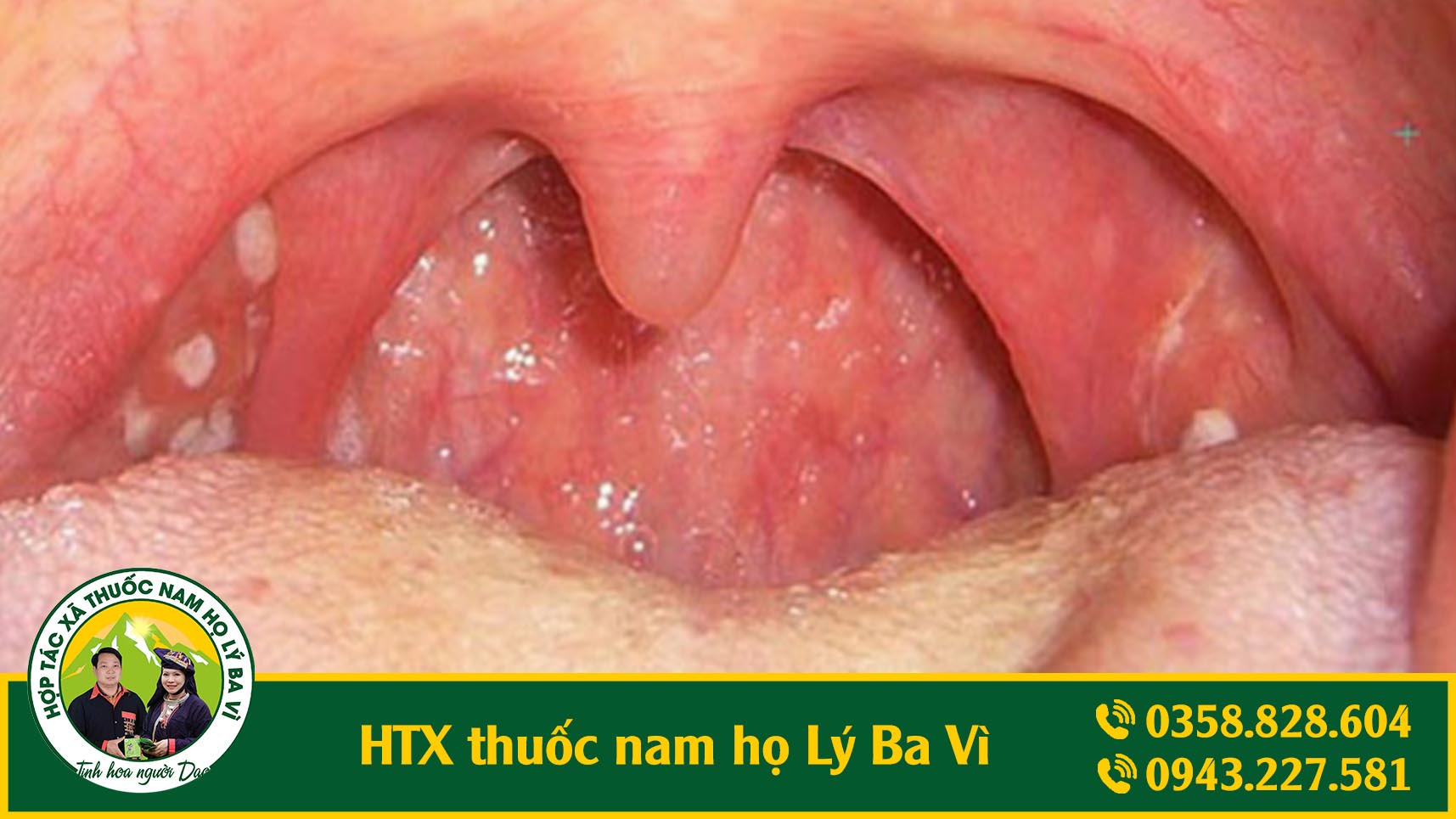 ung-thu-vom-hong