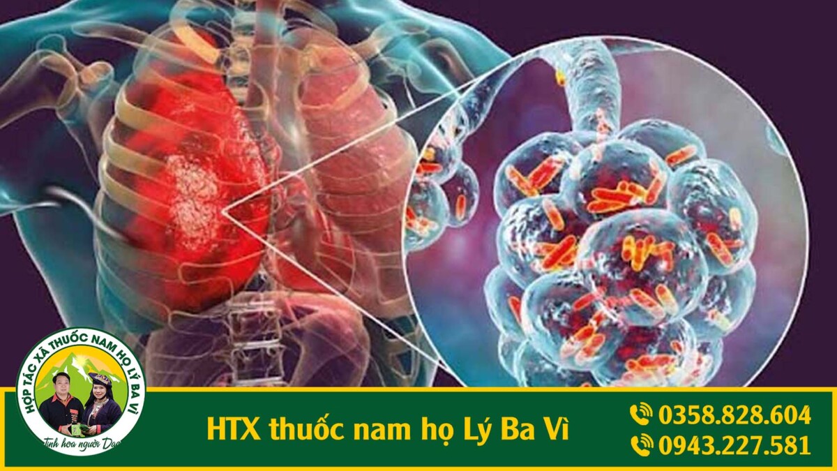 viêm phổi
