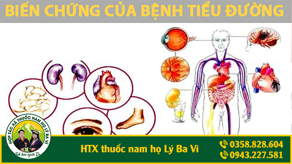 biến chứng bệnh tiểu đường