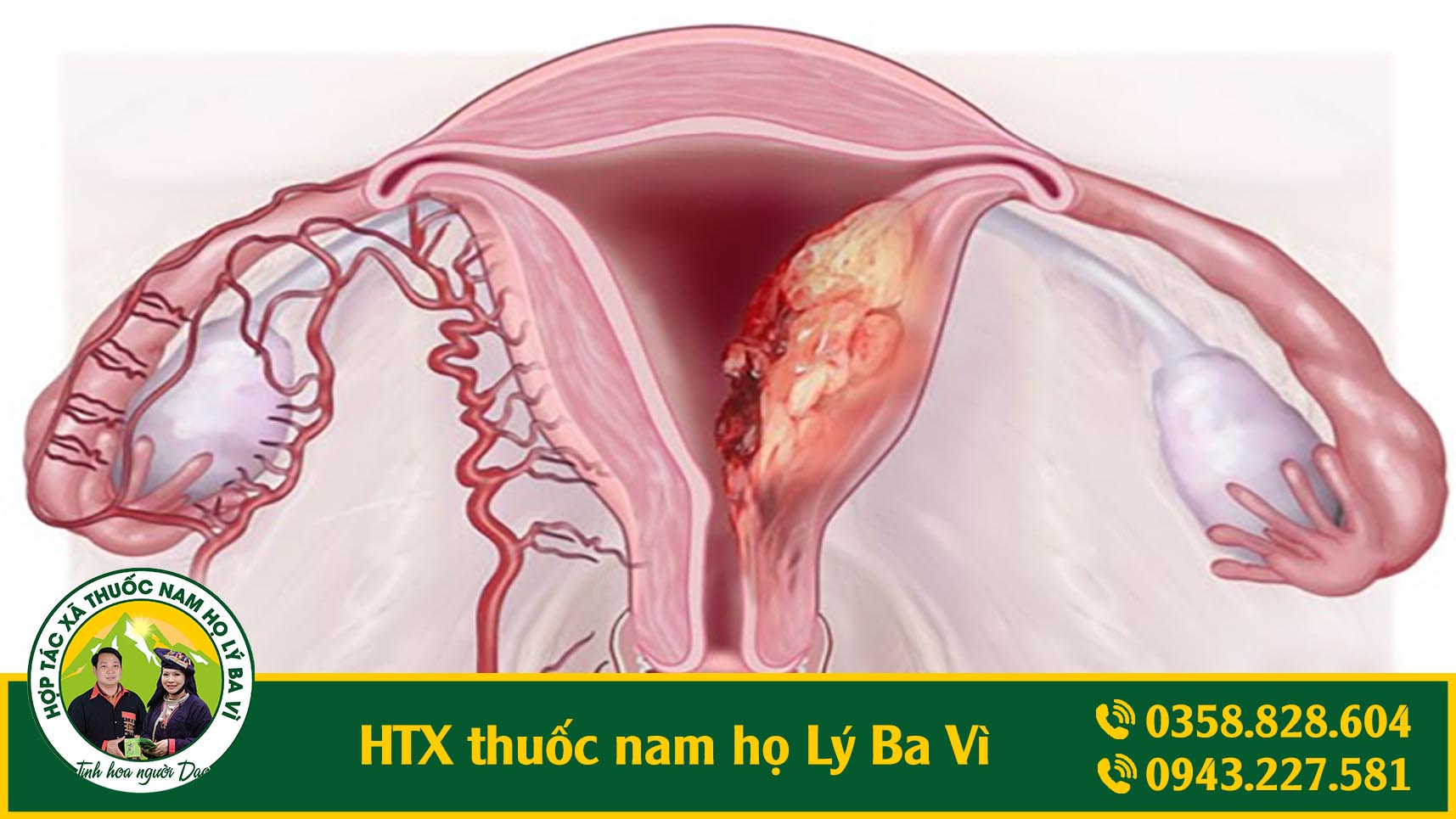 nội mạc tử cung