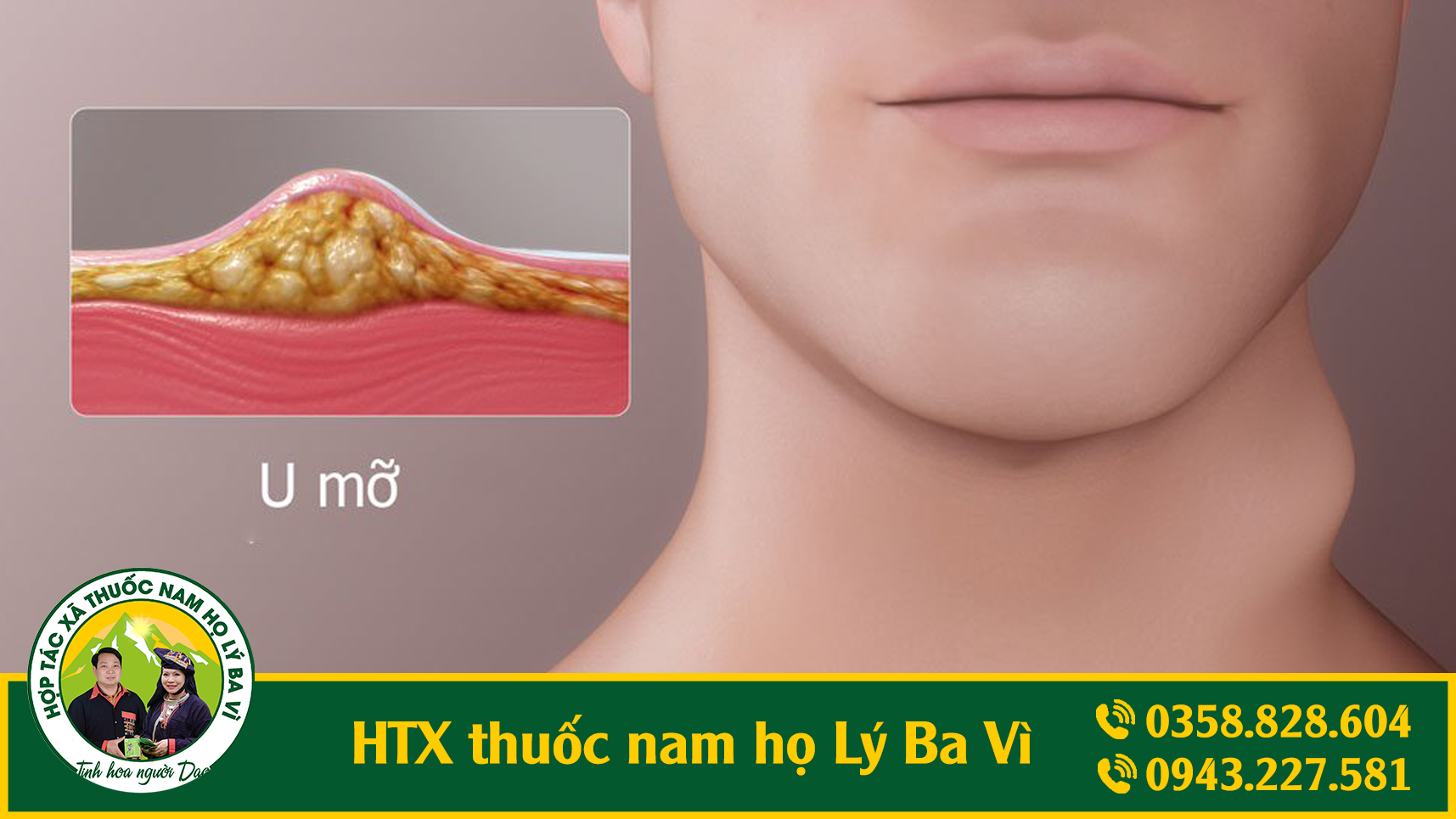htx_thuoc_nam_u_mo_anh_1