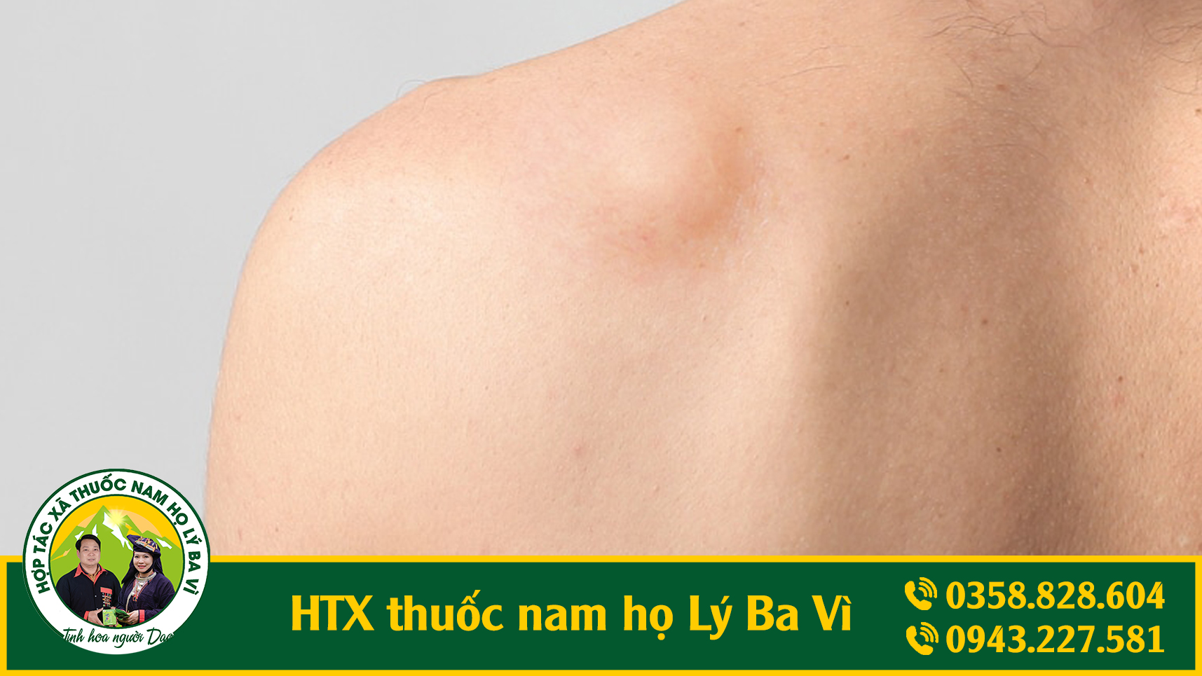 htx_thuoc_nam_u_mo_anh_2