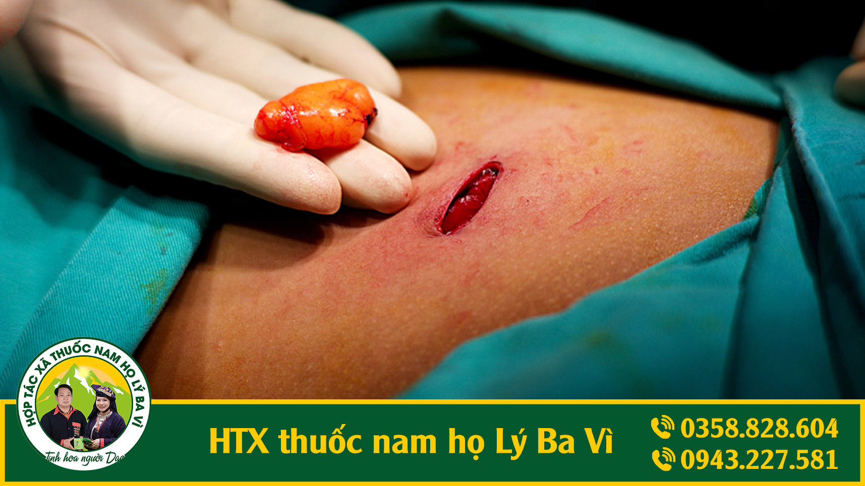 htx_thuoc_nam_u_mo_anh_3