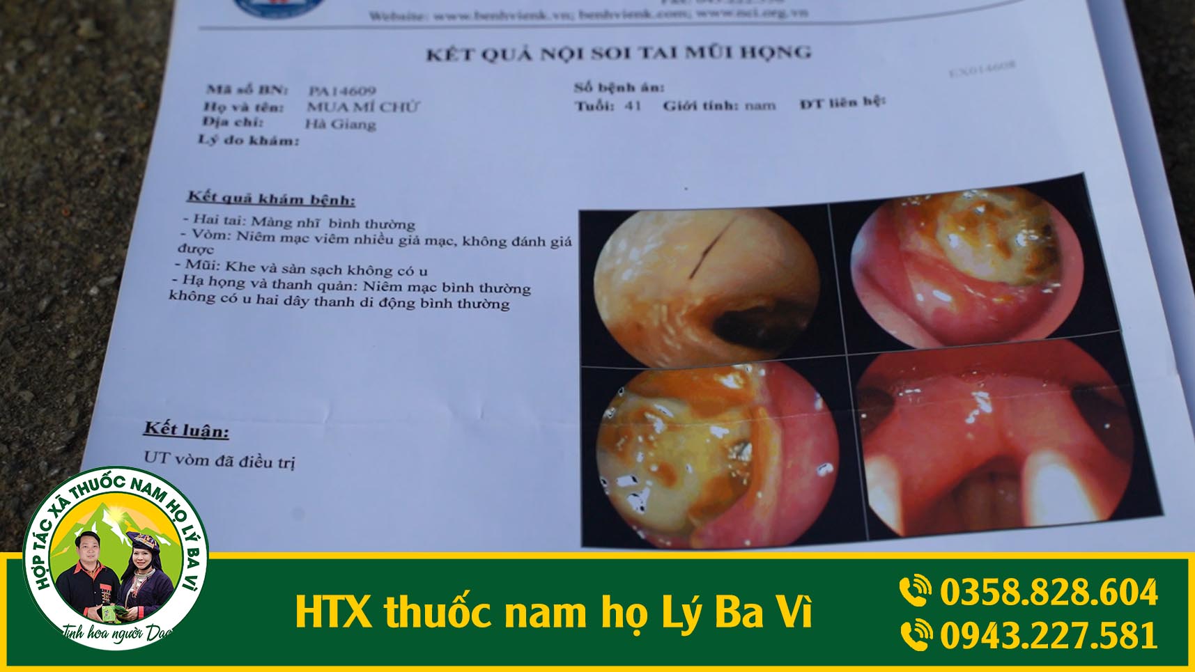 ung-thu-vom-hong