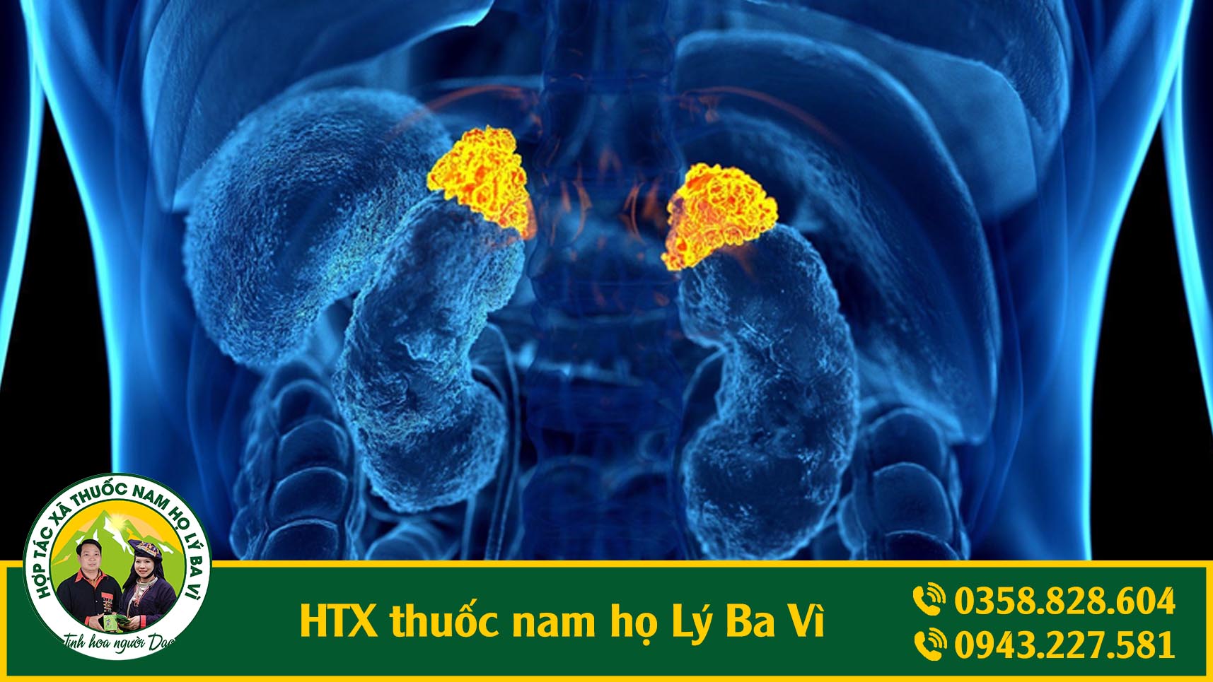 U TUYẾN THƯỢNG THẬN