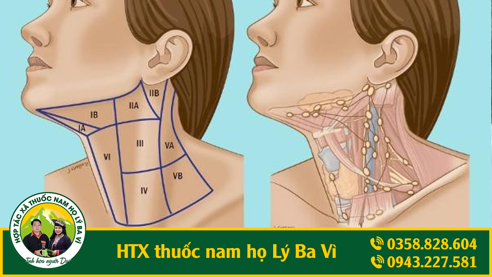 ung_thu_hach_htx_thuoc_nam_ho_ly_ba_vi_1
